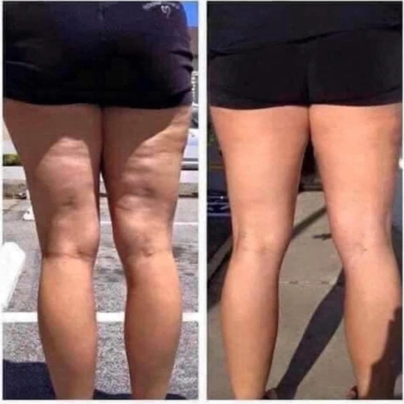 Smooth The Cellulite - Picture 2 of 7